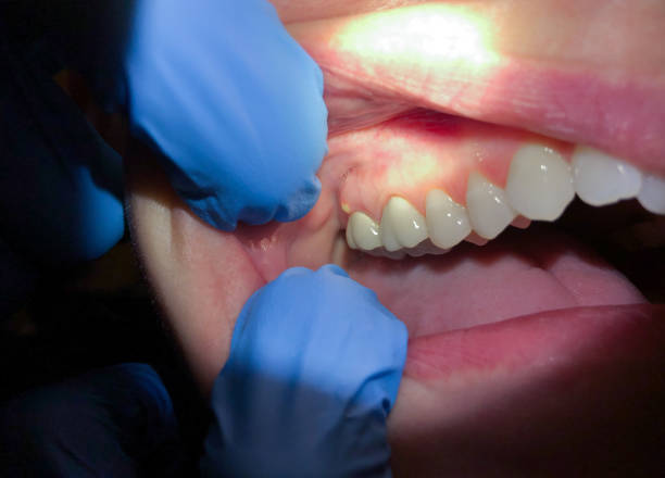 Best Emergency Wisdom Tooth Extraction in Budd Lake, NJ